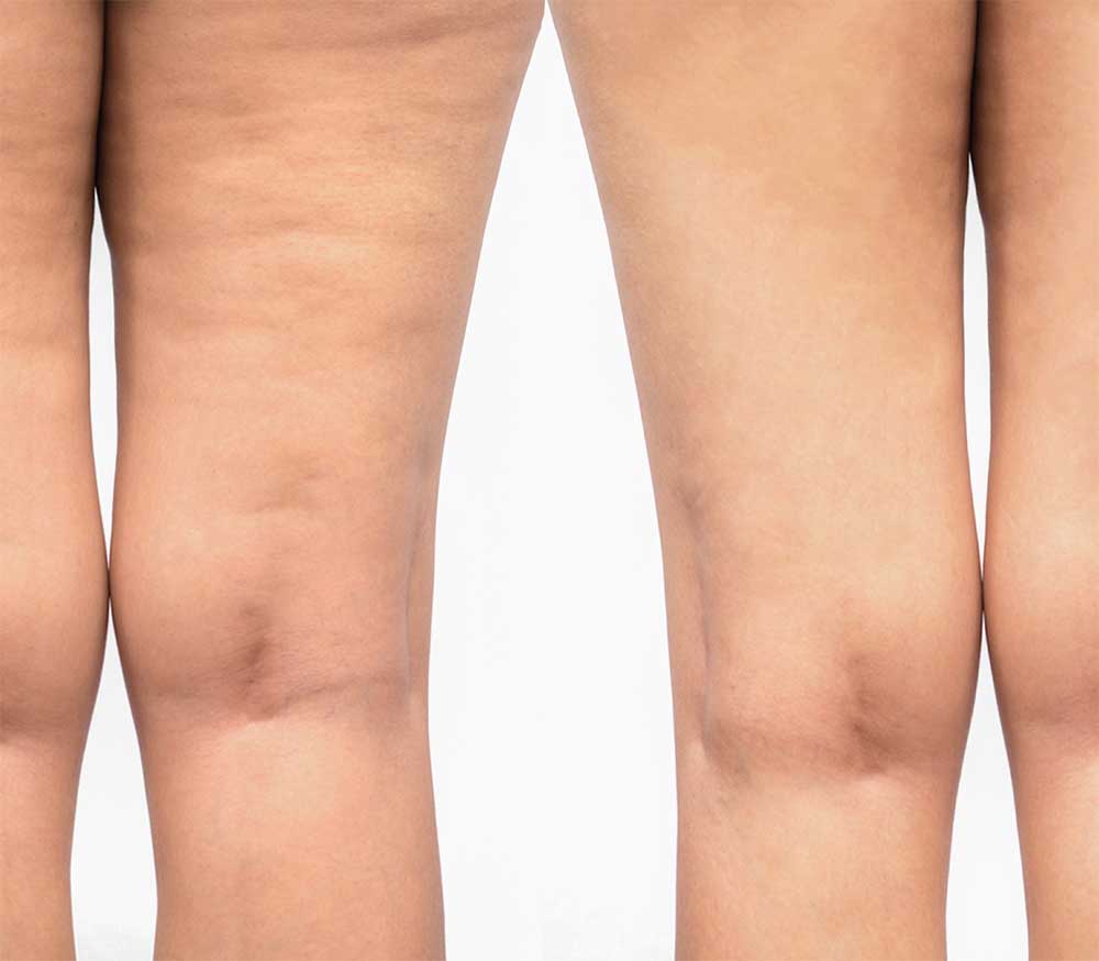 Trattamento soft medicina estetica per cellulite