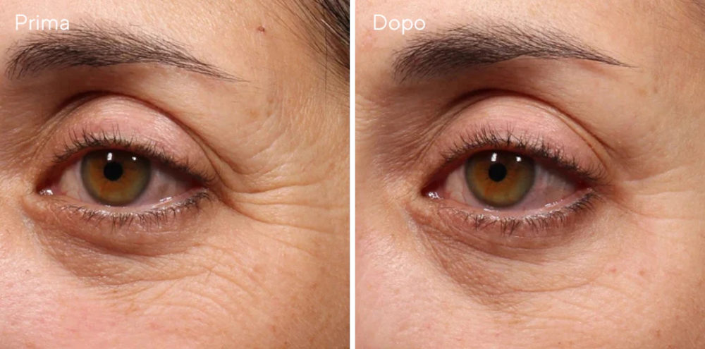 Prima e dopo utilizzo contorno occhi al retinolo